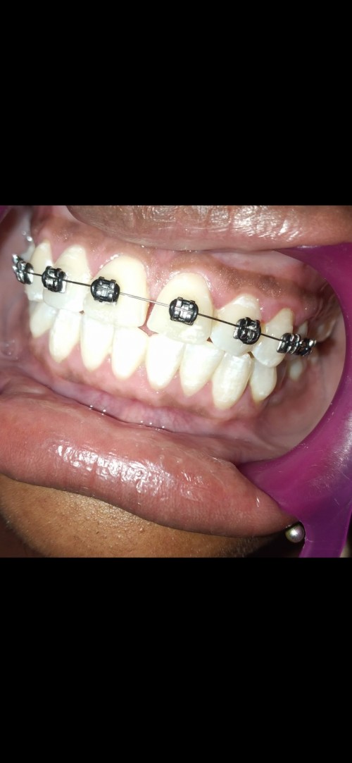 Braces