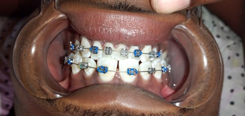 Braces