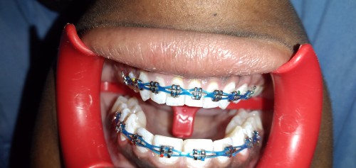 Braces