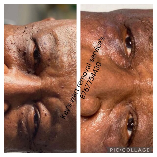 Wart Removal