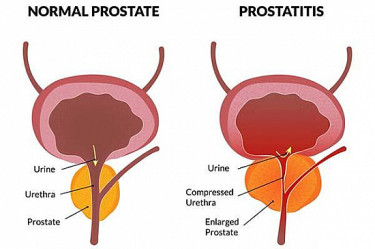 Erectile Dysfunction Treatment In Multan, Pakistan