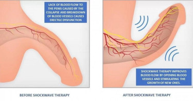 Erectile Dysfunction Treatment In Multan, Pakistan Healthcare Services Multan
