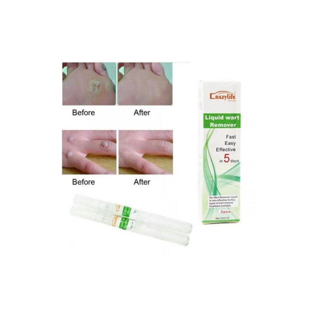 Liquid Wart Remover Skin Care Port Antonio | KGN | Ocho Rios | Stmary