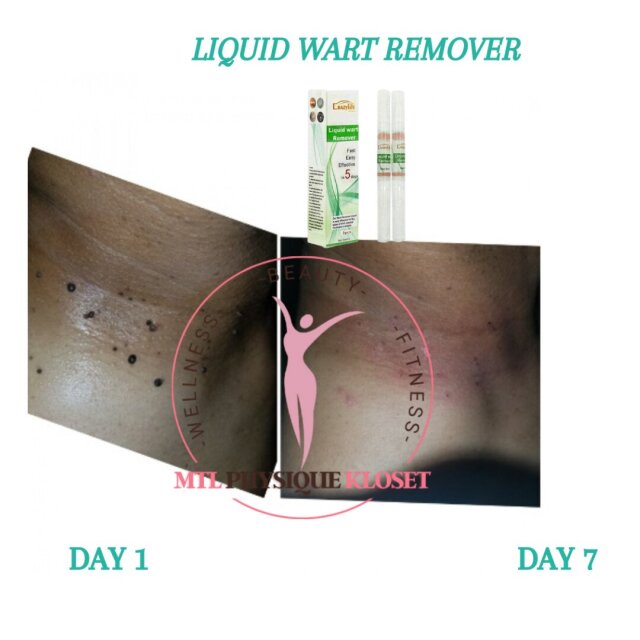 Liquid Wart Remover