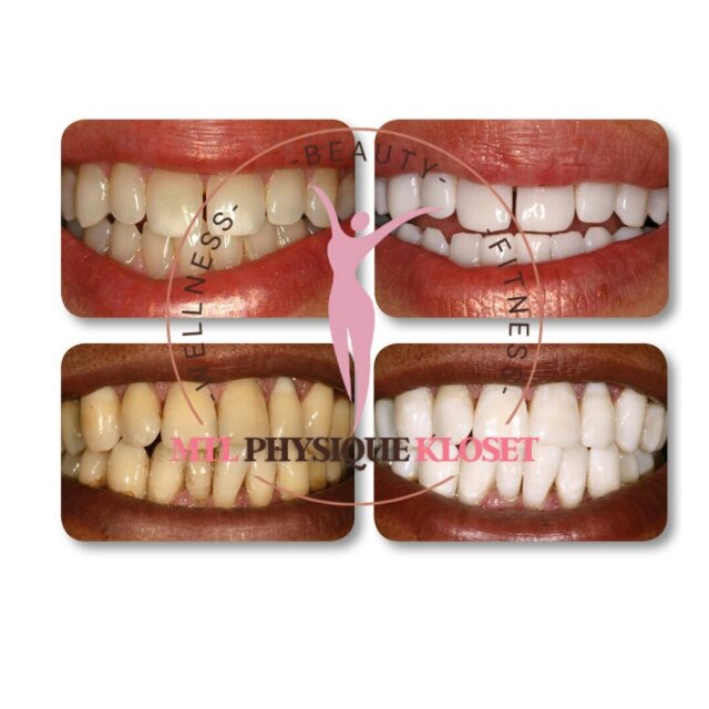 Mini Teeth Whitening Kit