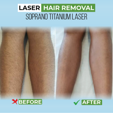 Say Goodbye To Unwanted Hair With Advanced Laser H