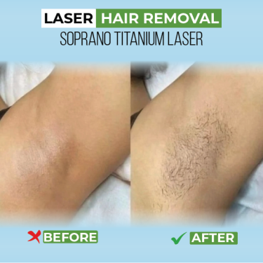 Say Goodbye To Unwanted Hair With Advanced Laser H