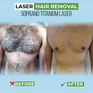 Say Goodbye To Unwanted Hair With Advanced Laser H Hair Kingston