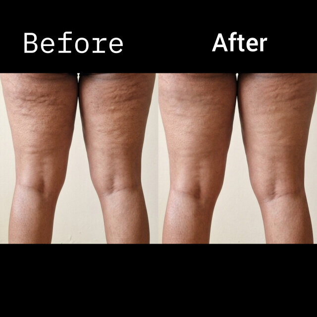 Anti Cellulite Gel Skin Care Kingston